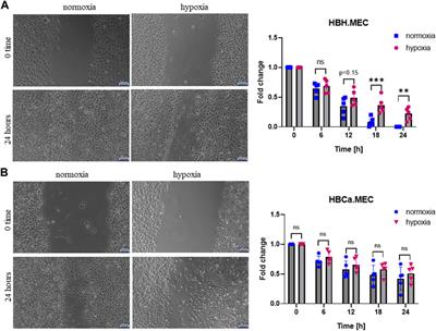 Microenvironment commits breast tumor ECs to dedifferentiation by micro-RNA-200-b-3p regulation and extracellular matrix remodeling